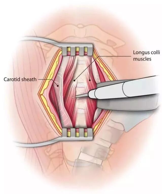 江伟博士前路颈3椎体脱位关节绞索复位内固定术