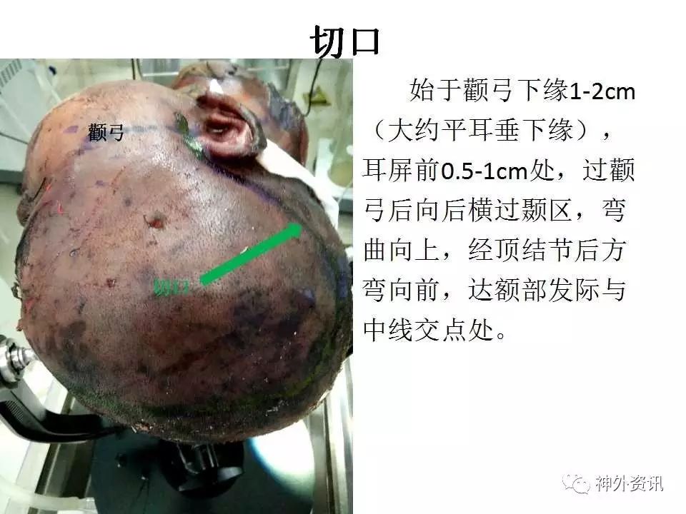 劉振林教授團隊:sta-m3搭橋,復發聽神經瘤切除手術,dolenc入路解剖