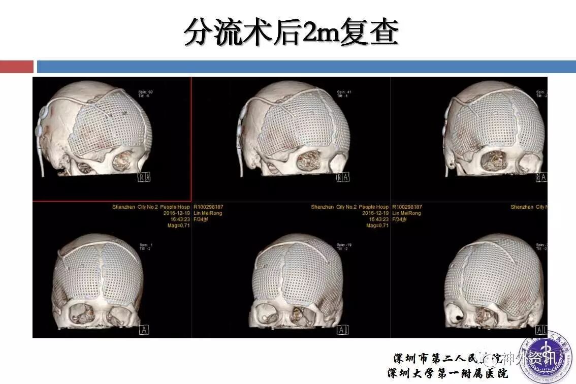 颅脑创伤神经重症病例周刊第8期双侧额颞顶去骨瓣减压术后双侧硬膜下