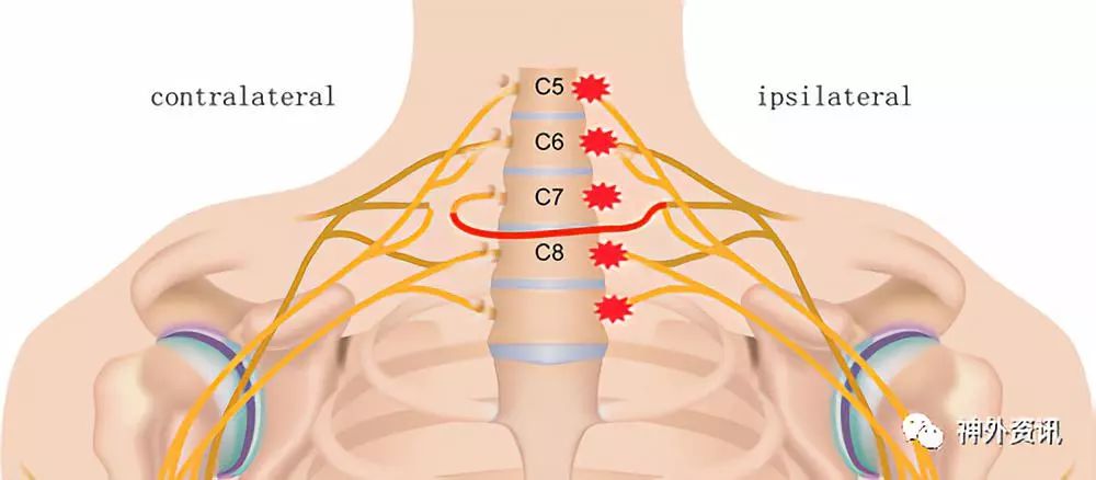 健侧颈7神经根移位治疗患侧肢体功能障碍