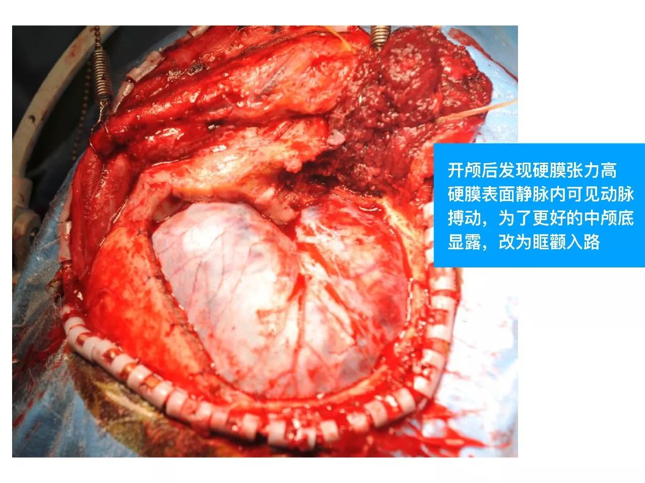 davf出血腦疝急診手術一例丨顱腦創傷神經重症病例週刊第49期