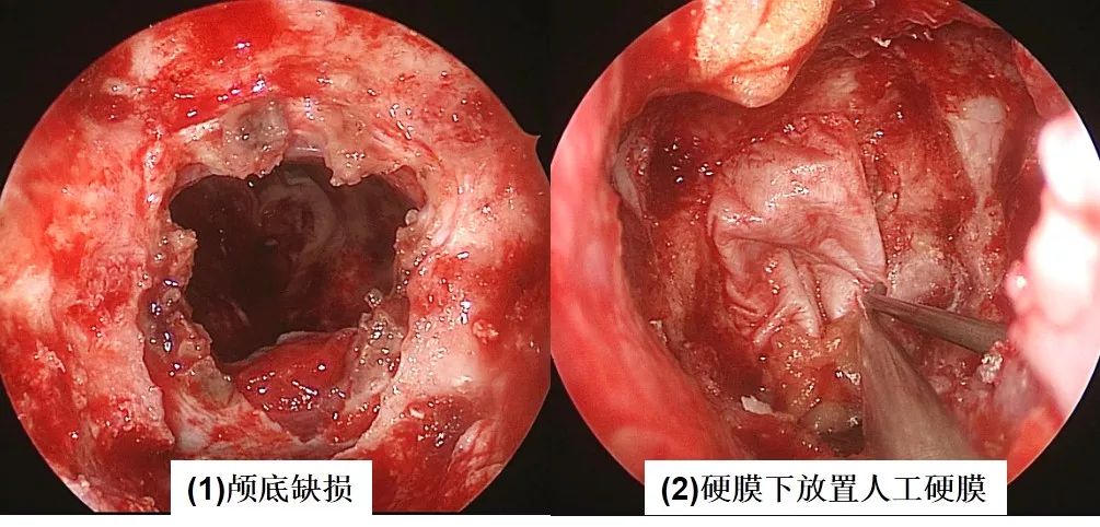 切除腫瘤過程ps:蝶骨平臺;ts:鞍結節;sf:鞍底;cl:斜坡;op:視神經管