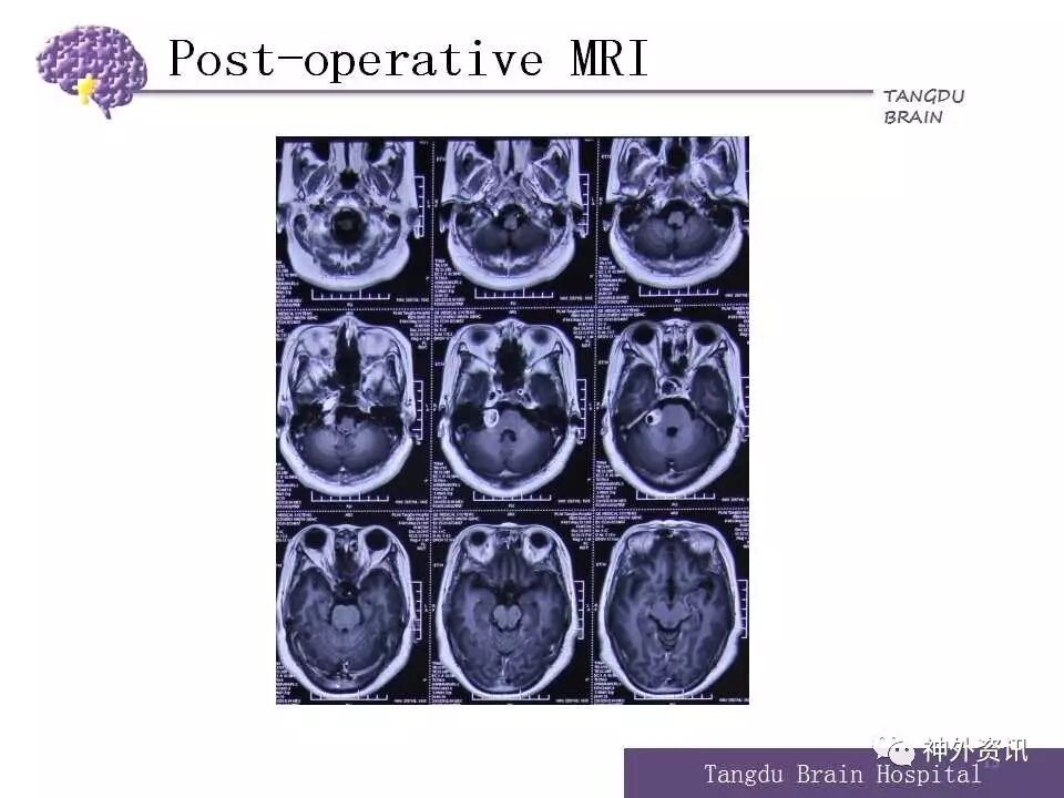 衡立君教授多模态导航监测技术辅助神经内镜下巨大垂体腺瘤切除术