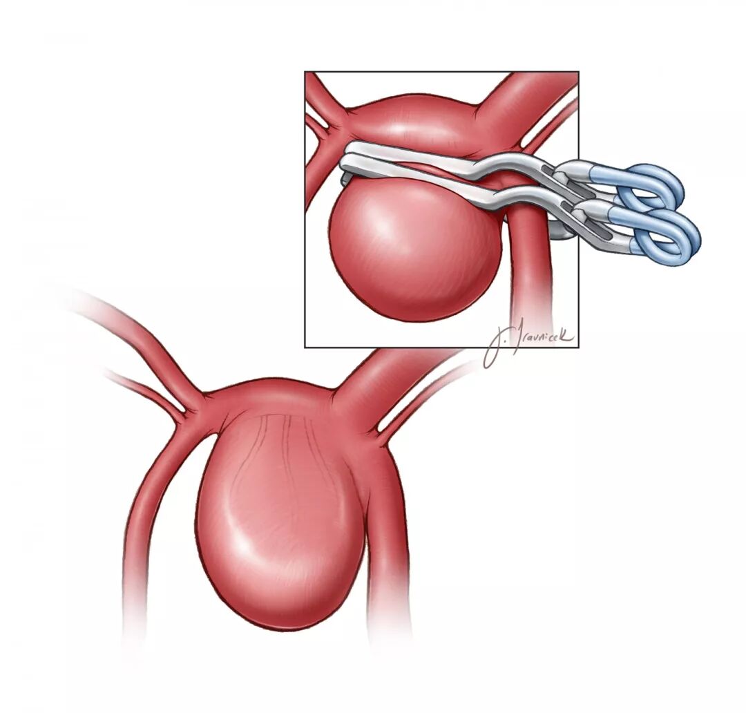 动脉瘤永久夹的使用策略与技巧theneurosurgicalatlas全文翻译