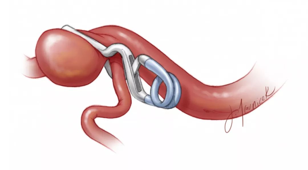 动脉瘤夹子图片图片