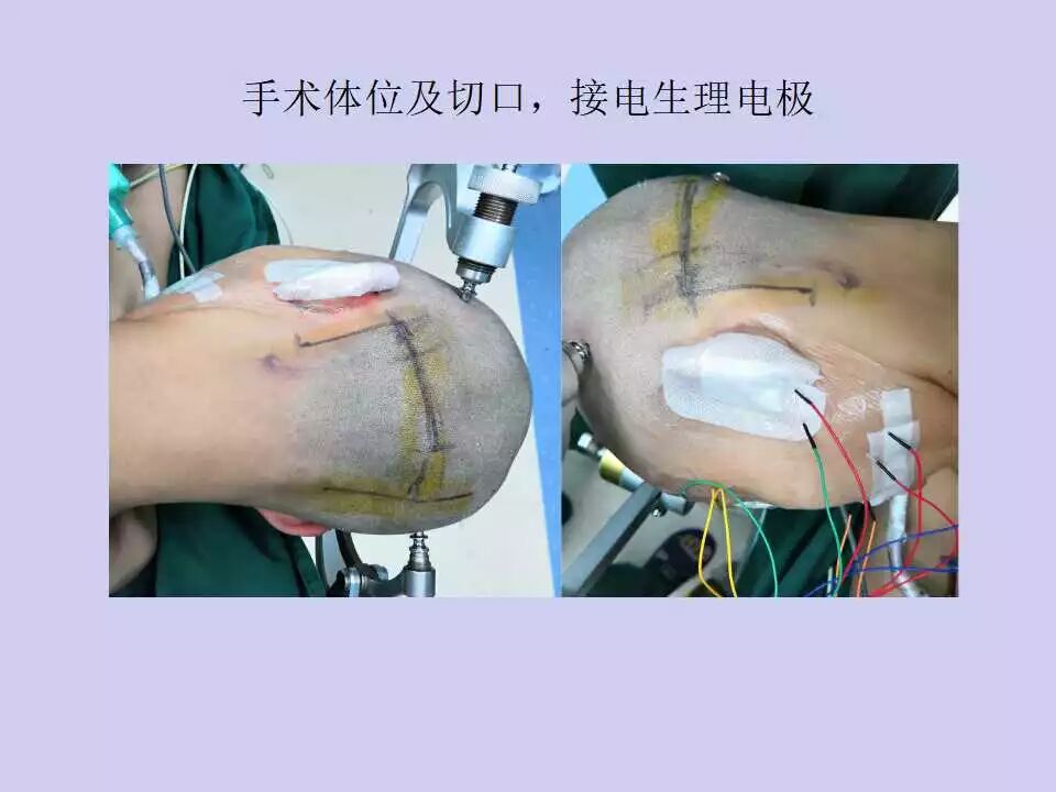 听瘤手术如何在术中确定乙状窦横窦转角的体表投影