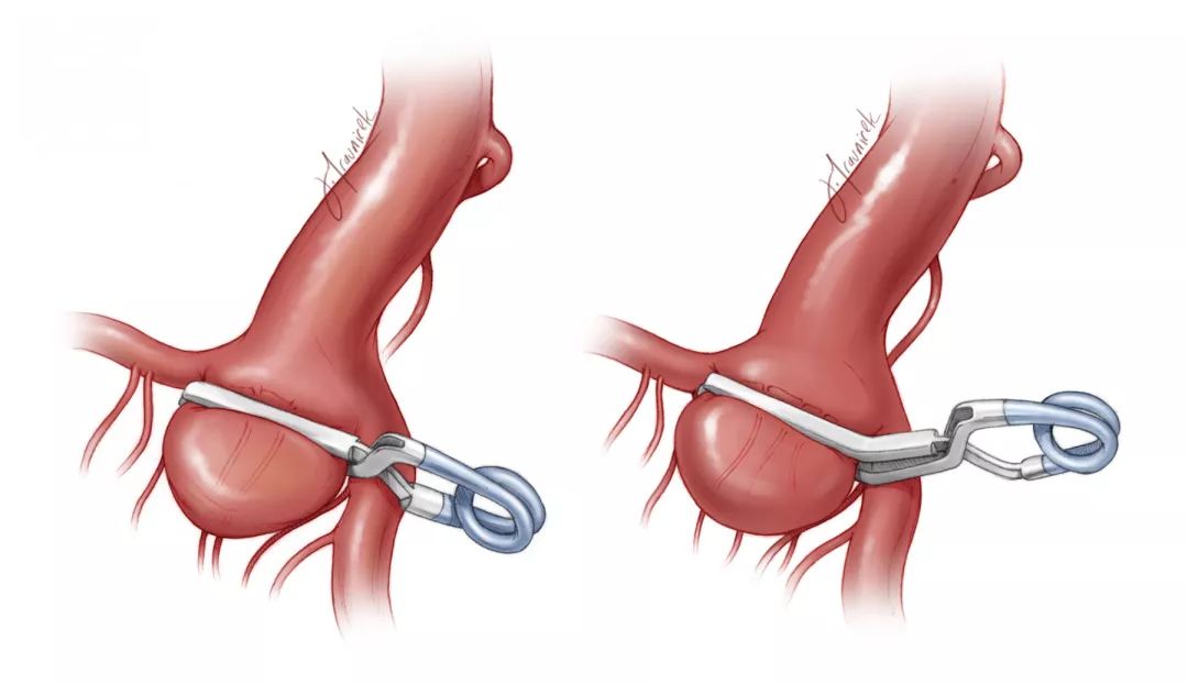 动脉瘤夹子图片图片