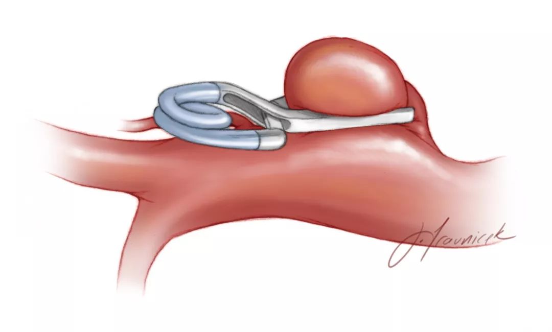 动脉瘤夹子图片图片