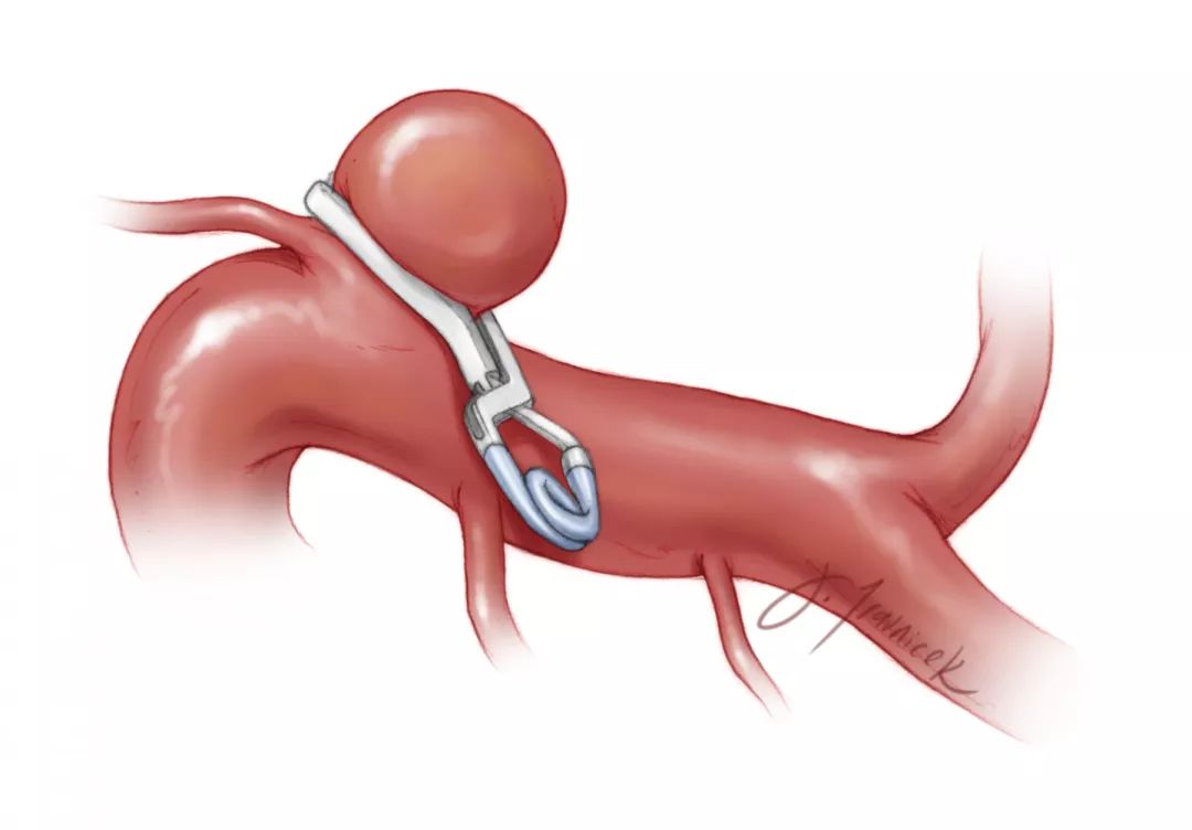 动脉瘤永久夹的使用策略与技巧theneurosurgicalatlas全文翻译