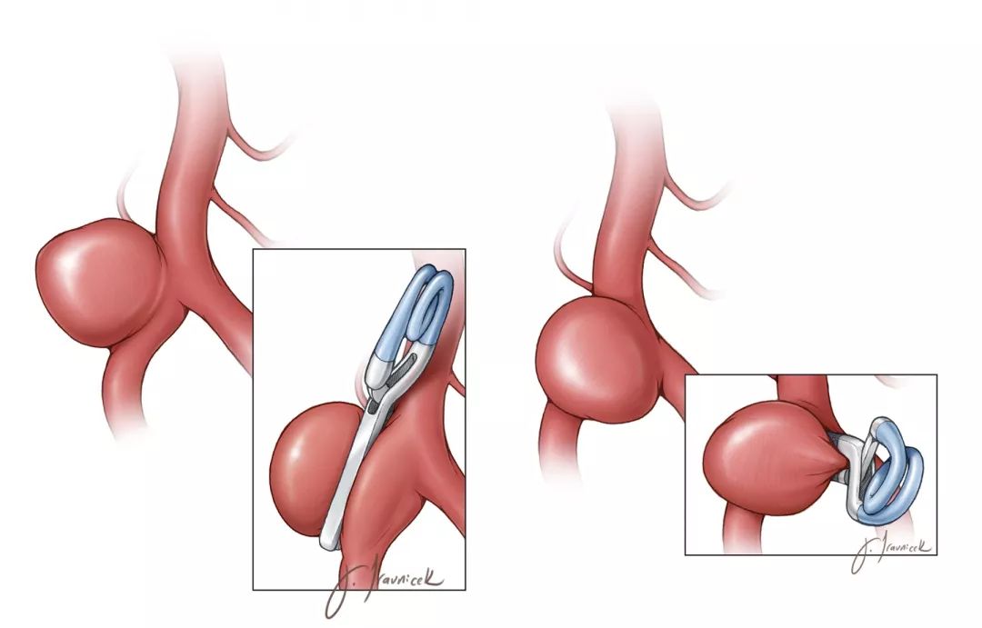 动脉瘤夹子图片图片
