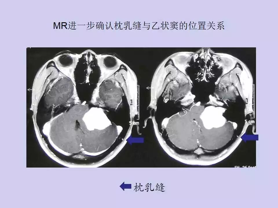 听瘤手术如何在术中确定乙状窦横窦转角的体表投影