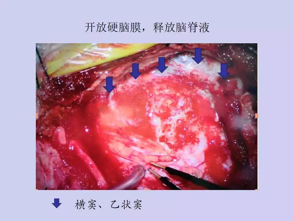 听瘤手术如何在术中确定乙状窦横窦转角的体表投影