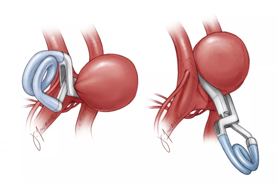 动脉瘤夹子图片图片