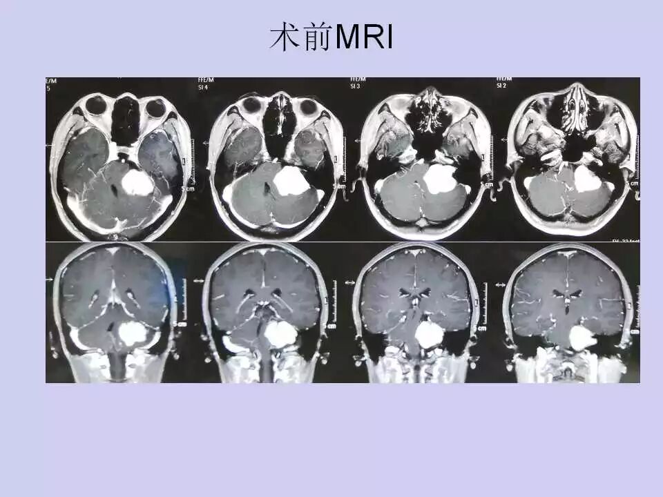 听瘤手术如何在术中确定乙状窦横窦转角的体表投影