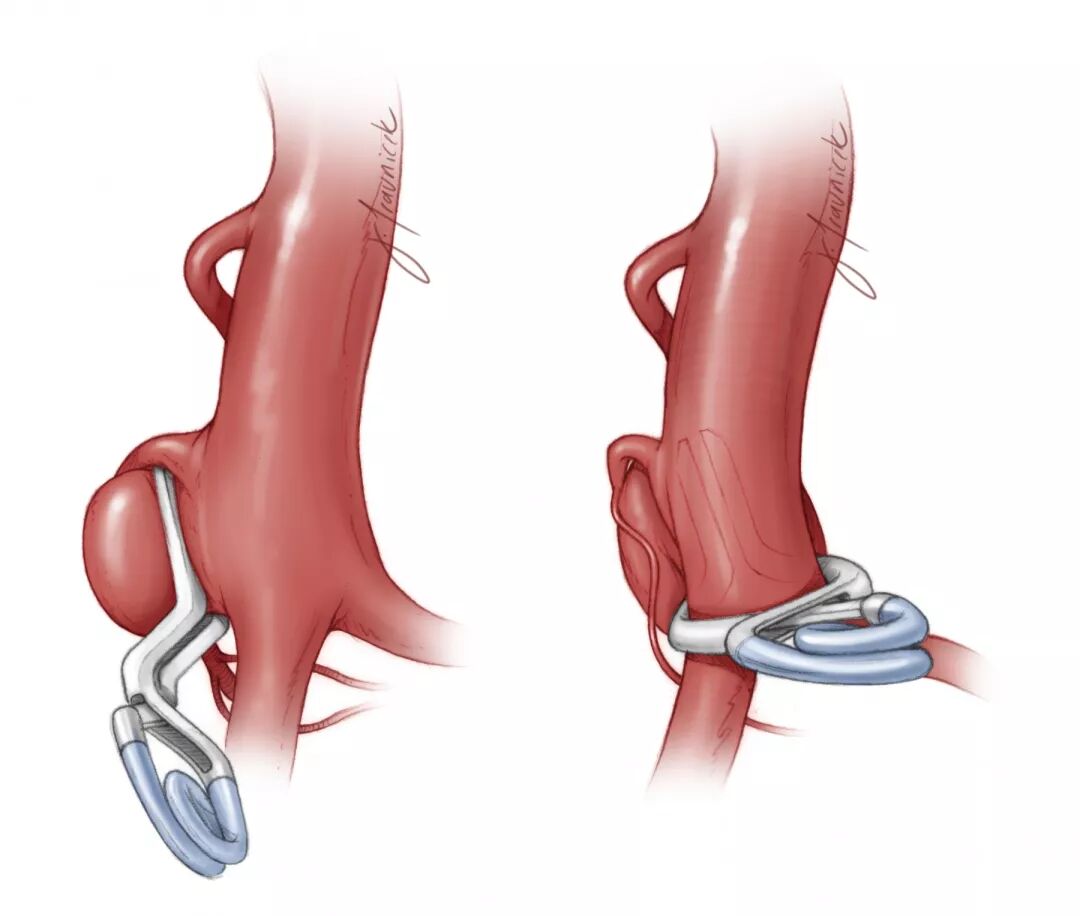 动脉瘤永久夹的使用策略与技巧theneurosurgicalatlas全文翻译
