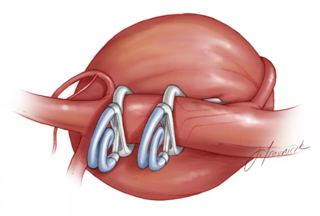 动脉瘤永久夹的使用策略与技巧theneurosurgicalatlas全文翻译