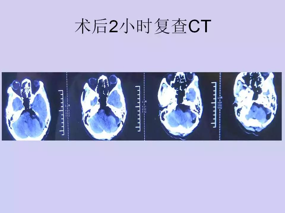 乙状窦体表投影图片