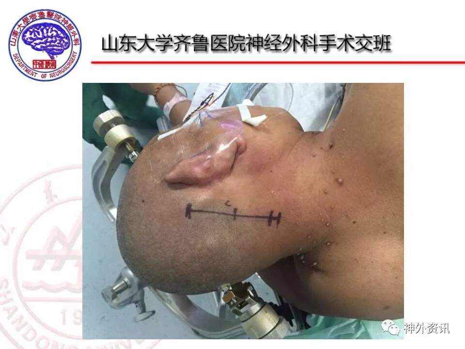 乙状窦后入路无血快速开关颅技术标准化操作流程sop