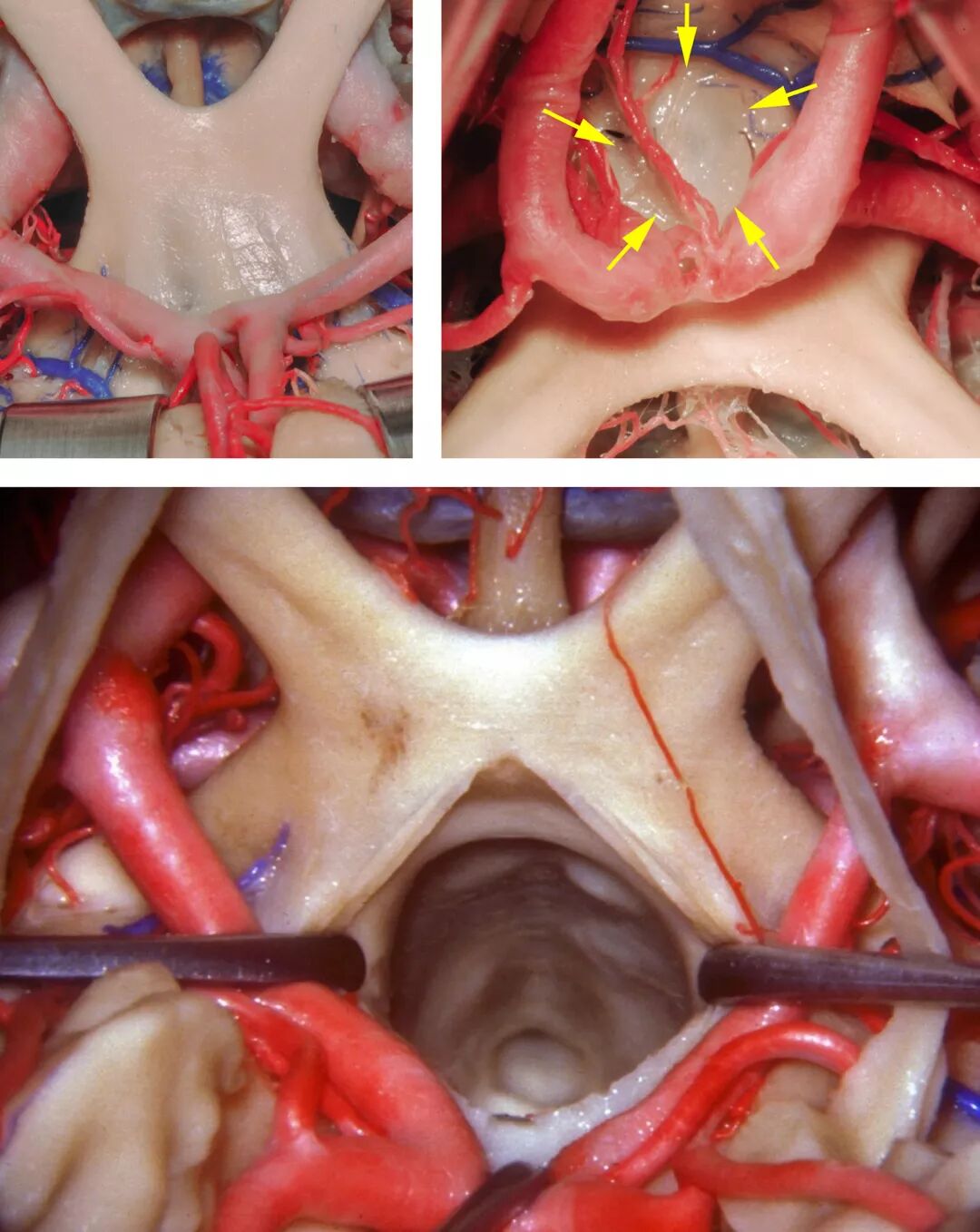 额下经终板入路开颅手术策略与技巧theneurosurgicalatlas全文翻译