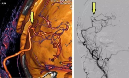 脑血管搭桥重建崭新人生盛京医院喻博教授在烟雾病治疗中的进展