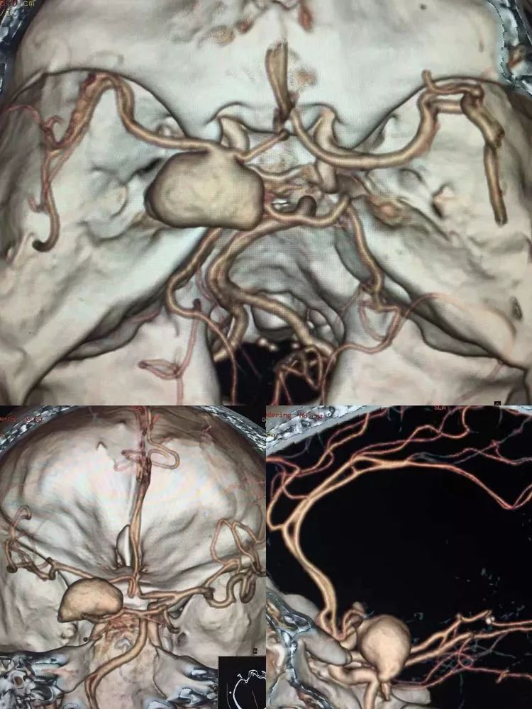 颅内动脉瘤图片高清图片