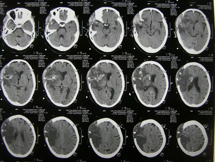 一例大面積出血性腦梗死合併心肺功能衰竭患者的成功