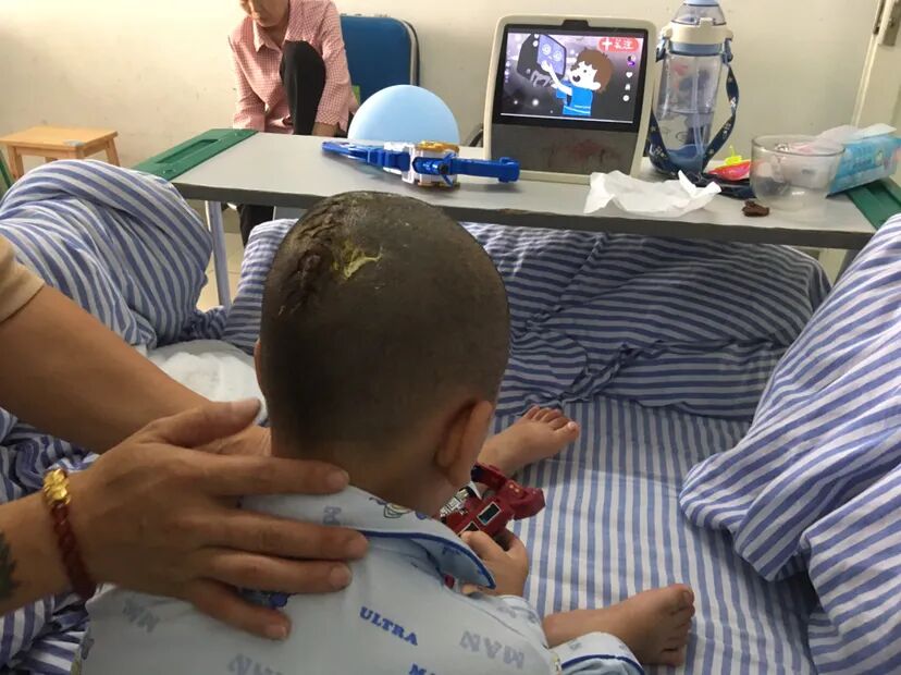 手术头皮夹怎么放【病例分享】刘国平主任医师：一例枕部脑膜脑膨出的手术治疗_https://www.jmylbn.com_新闻资讯_第20张