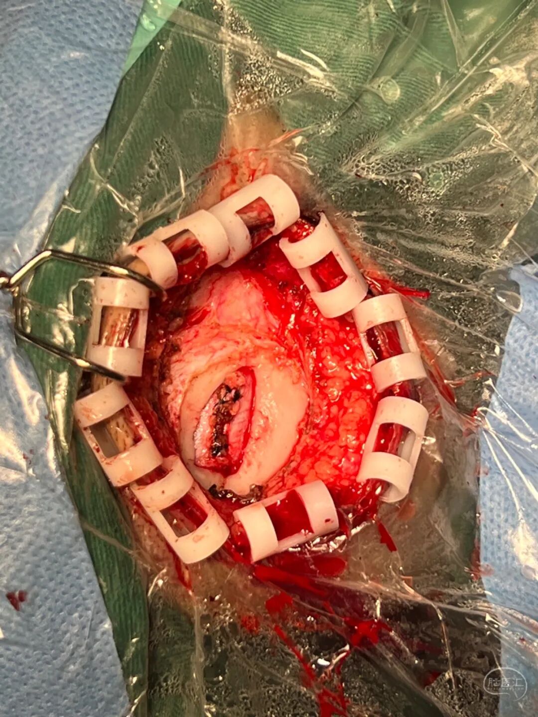 手术头皮夹怎么放【病例分享】刘国平主任医师：一例枕部脑膜脑膨出的手术治疗_https://www.jmylbn.com_新闻资讯_第17张