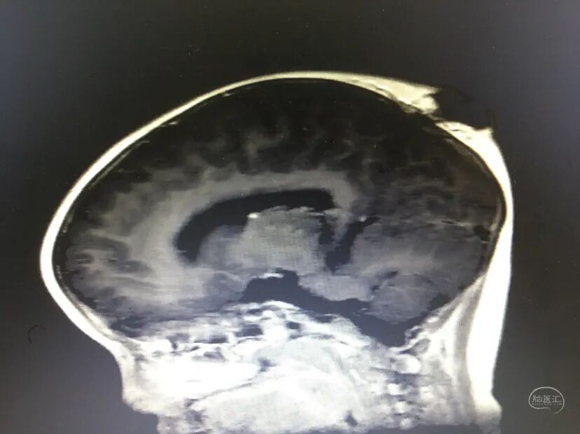 手术头皮夹怎么放【病例分享】刘国平主任医师：一例枕部脑膜脑膨出的手术治疗_https://www.jmylbn.com_新闻资讯_第9张