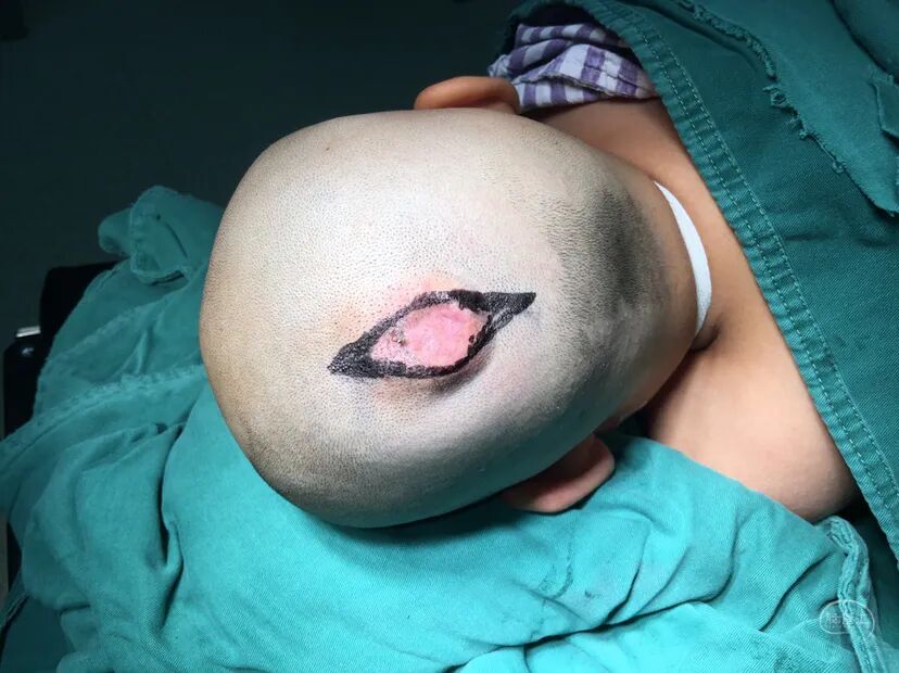 手术头皮夹怎么放【病例分享】刘国平主任医师：一例枕部脑膜脑膨出的手术治疗_https://www.jmylbn.com_新闻资讯_第14张