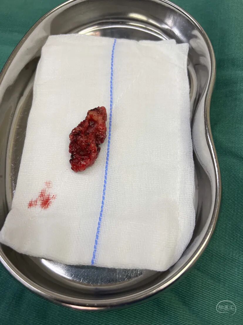 手术头皮夹怎么放【病例分享】刘国平主任医师：一例枕部脑膜脑膨出的手术治疗_https://www.jmylbn.com_新闻资讯_第15张