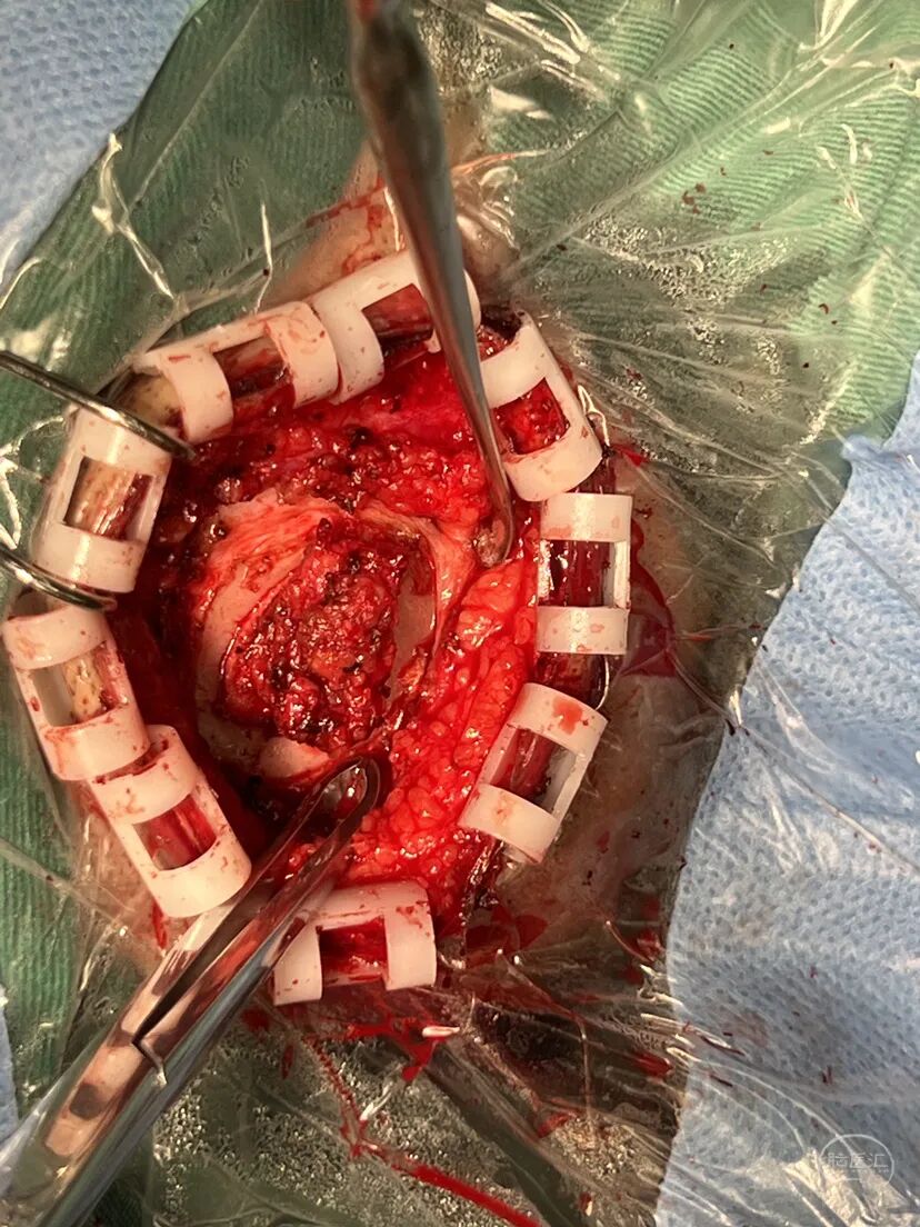 手术头皮夹怎么放【病例分享】刘国平主任医师：一例枕部脑膜脑膨出的手术治疗_https://www.jmylbn.com_新闻资讯_第16张