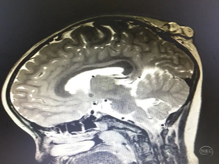 手术头皮夹怎么放【病例分享】刘国平主任医师：一例枕部脑膜脑膨出的手术治疗_https://www.jmylbn.com_新闻资讯_第8张