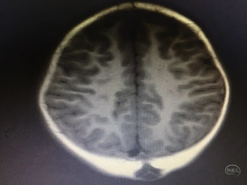 手术头皮夹怎么放【病例分享】刘国平主任医师：一例枕部脑膜脑膨出的手术治疗_https://www.jmylbn.com_新闻资讯_第7张