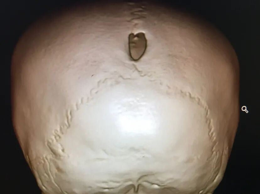 手术头皮夹怎么放【病例分享】刘国平主任医师：一例枕部脑膜脑膨出的手术治疗_https://www.jmylbn.com_新闻资讯_第6张