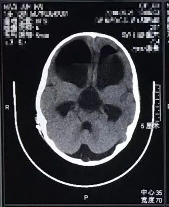 张冰克教授鞍上池蛛网膜囊肿造瘘后分流一例