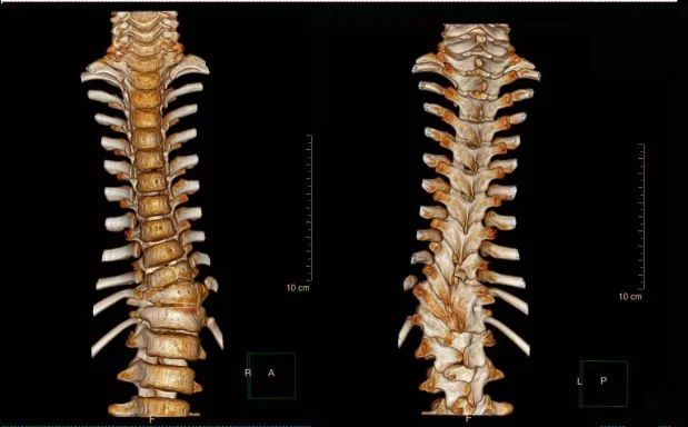 赵红宇教授脊柱裂治疗策略选择附病例1例