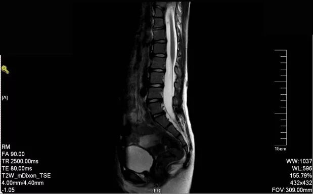 赵红宇教授:脊柱裂治疗策略选择-附病例1例