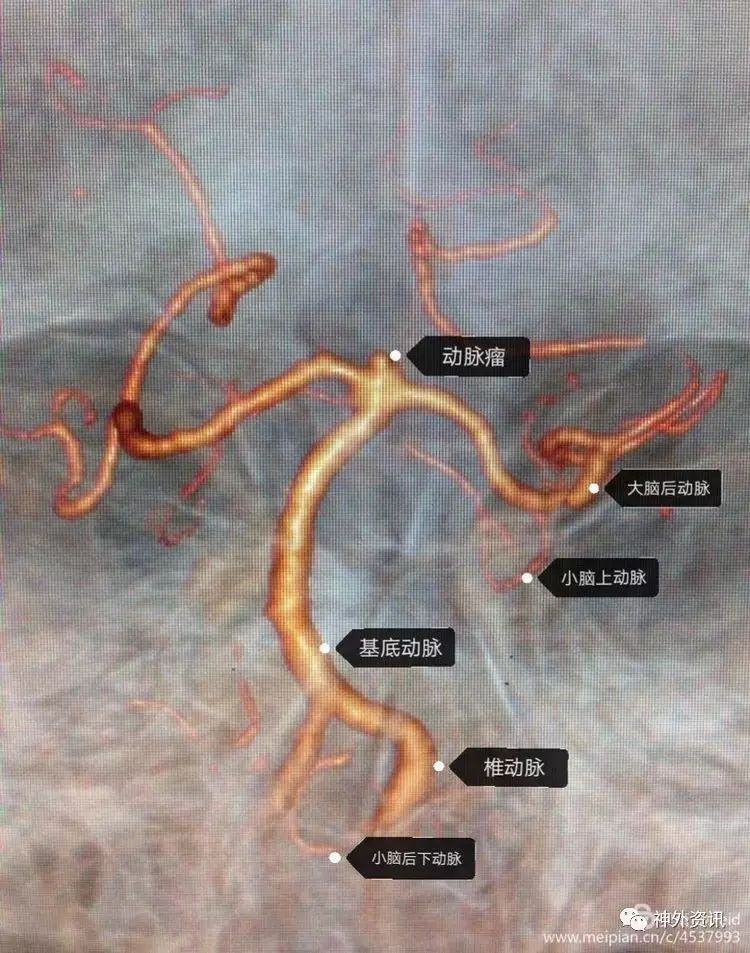 病例分享高位基底動脈尖動脈瘤合併左側大腦中動脈動脈瘤顯微外科夾閉