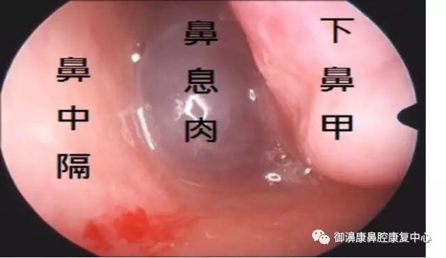 了解了鼻息肉，才知道鼻炎不可小觑！