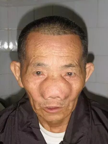 “巨鼻症”竟然与鼻炎有关！