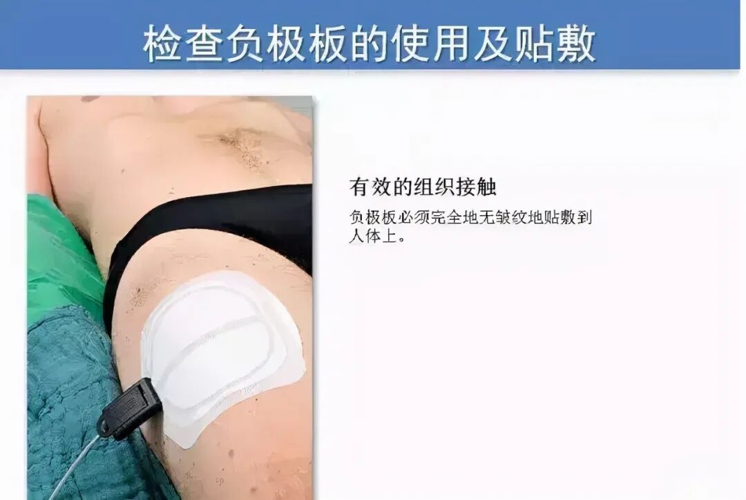 为什么手术用电刀手术室高频电刀安全与负极板那些事_https://www.jmylbn.com_新闻资讯_第4张