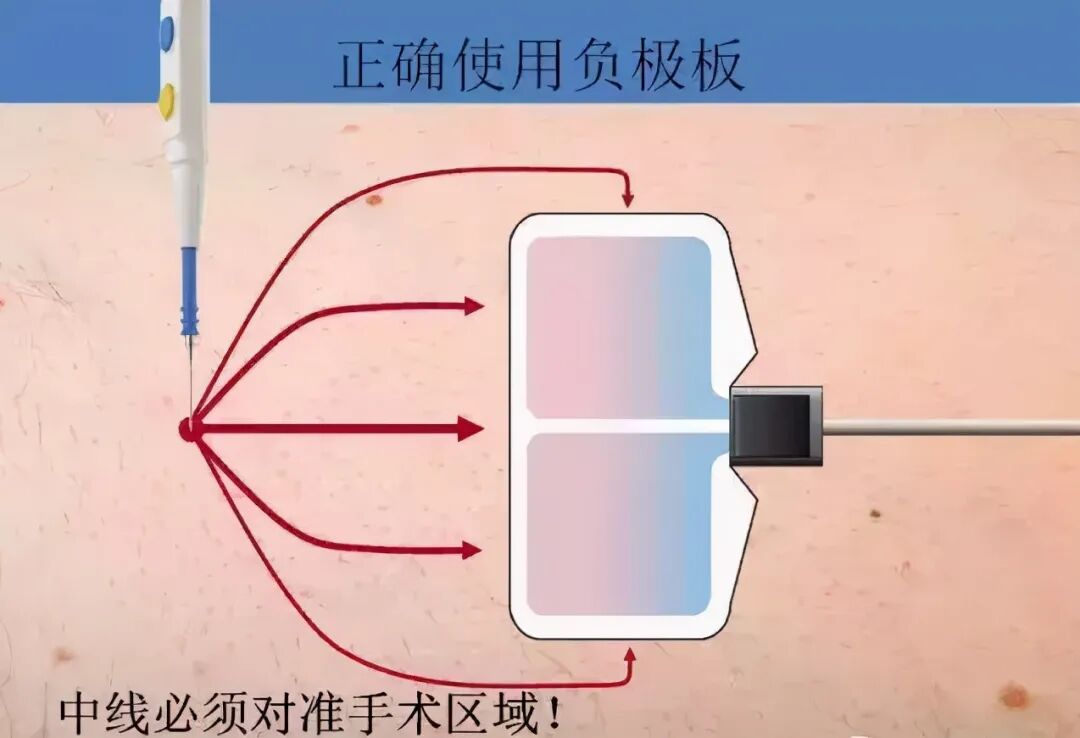 为什么手术用电刀手术室高频电刀安全与负极板那些事_https://www.jmylbn.com_新闻资讯_第6张