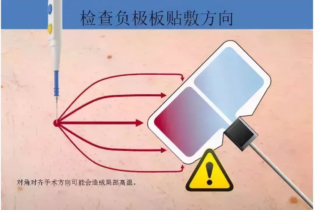 为什么手术用电刀手术室高频电刀安全与负极板那些事_https://www.jmylbn.com_新闻资讯_第5张