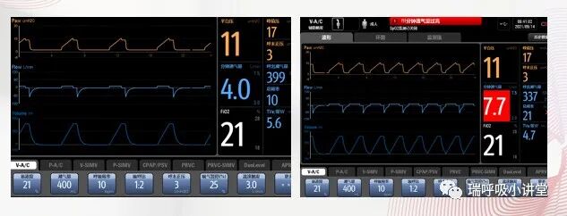 吸呼比怎么调机械通气误区：患者的吸呼比就是我设置的吸呼比_https://www.jmylbn.com_新闻资讯_第1张