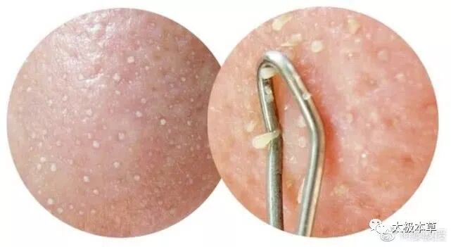 脂溢性皮炎的病因、症状、并发症、治疗与预防