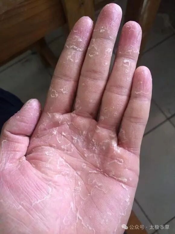 老中医的一草二皮汤治疗手足癣、灰指甲效果好