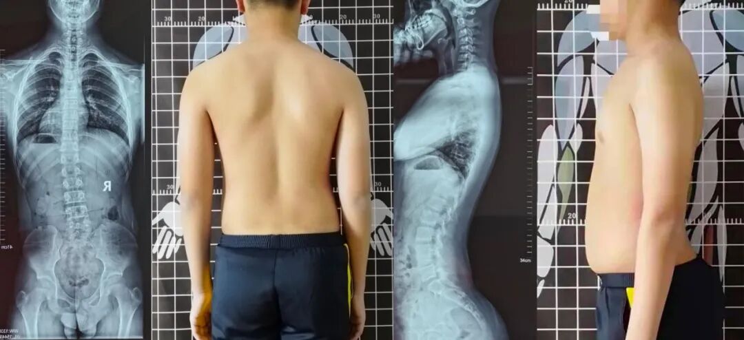 步态分析上曲线怎么解读青少年脊柱侧凸保守矫形康复评估体系—步态分析_https://www.jmylbn.com_新闻资讯_第18张