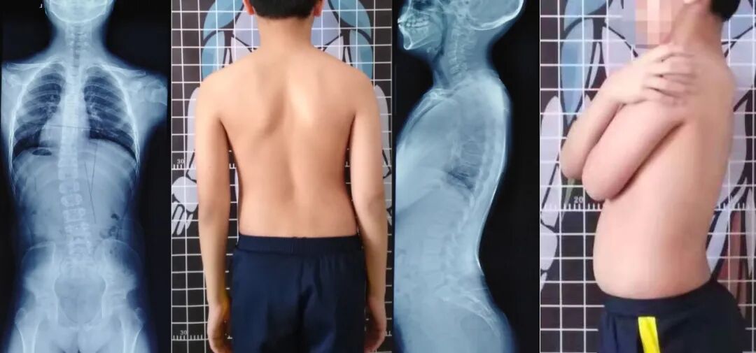 步态分析上曲线怎么解读青少年脊柱侧凸保守矫形康复评估体系—步态分析_https://www.jmylbn.com_新闻资讯_第12张