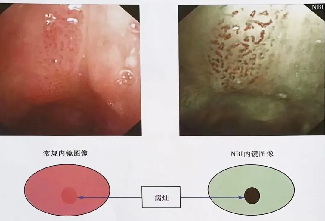 电子喉镜怎么操作电子鼻咽喉镜检查全流程指引_https://www.jmylbn.com_新闻资讯_第3张